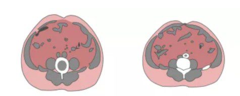 和聚CECT8145(BPL1)益生菌降低內臟脂肪